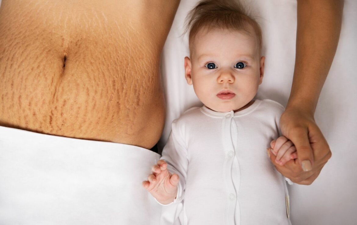 Remedii Naturale Pentru Vergeturi